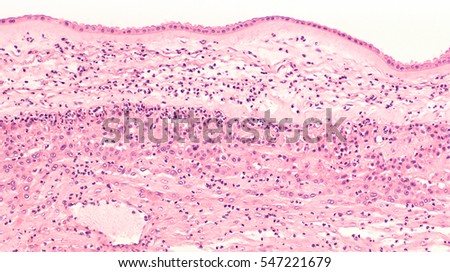 Acute chorioamnionitis is an infection of placental membranes in which there is an infiltration of acute inflammatory cells (neutrophils).  Often associated with spontaneous rupture of membranes, SROM Royalty-Free Stock Photo #547221679