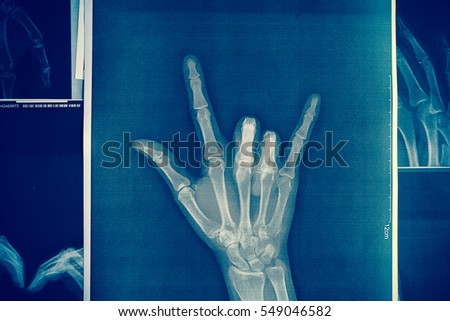 x-ray image of a hand making I love you symbols.