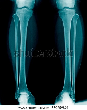 x-ray both leg show normal alignment Royalty-Free Stock Photo #550259821