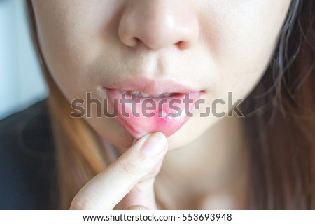 Woman with aphthae on lip. Royalty-Free Stock Photo #553693948