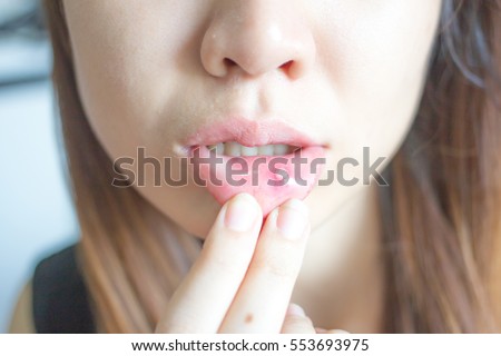 Woman with aphthae on lip. Royalty-Free Stock Photo #553693975