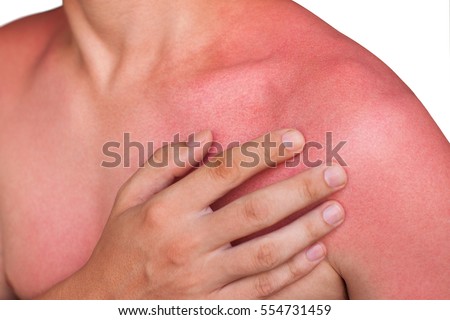 A man with reddened, itchy skin after sunburn. Skin care and protection from the sun's ultraviolet rays.