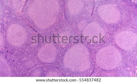 Lymphoma Awareness: Microscopic image of follicular lymphoma, a type of non-Hodgkin lymphoma, a cancer of lymphocytes associated with enlarged lymph nodes.   Royalty-Free Stock Photo #554837482