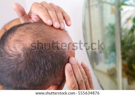 Middle-aged man concerned with hair loss. Baldness Royalty-Free Stock Photo #555634876