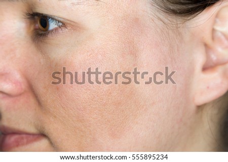 Young woman with pigmented skin / chloasma on her cheeks Royalty-Free Stock Photo #555895234