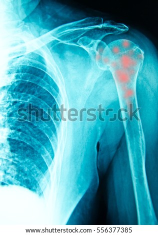 shoulder  x-ray for diagnosis with inflamatory bone