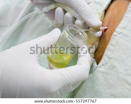 Close up of release ascites in abdomen in abdominal paracentesis procedure Royalty-Free Stock Photo #557297767