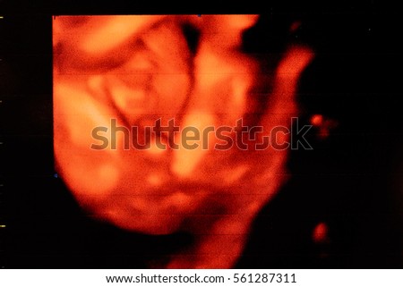 Picture 4D Ultrasound of baby in mother's womb : (Gestational age of 20 weeks / 5 months)