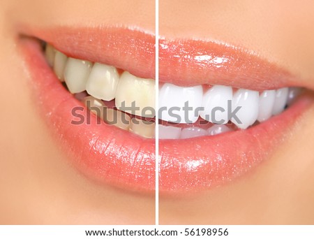woman teeth before and after whitening. Over white background Royalty-Free Stock Photo #56198956