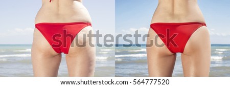 Female buttocks before and after cellulite