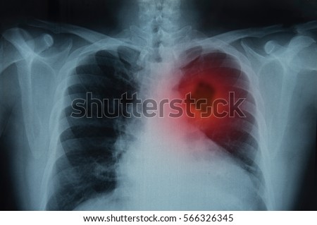 Lung Cancer or Pneumonia. X-ray image of patient lungs to lung tumor. Royalty-Free Stock Photo #566326345