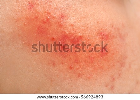 Acne treatment concept. Skin irritation, closeup Royalty-Free Stock Photo #566924893