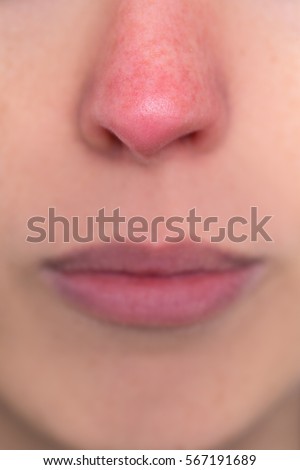 close up, young woman with a red nose, allergy, hypothermia or rosacea Royalty-Free Stock Photo #567191689
