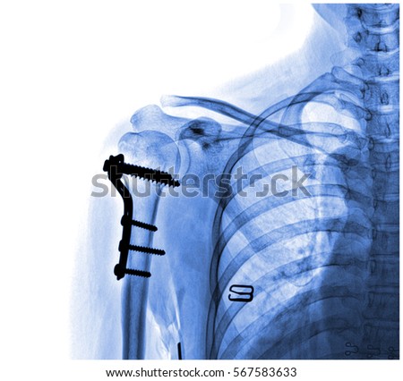  arm fracture fixed X-ray photography