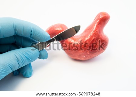 Concept of gastric surgery. Surgeon holding scalpel near anatomical model of stomach. Surgery operations and treatment of diseases of stomach same as ulcer, cancer, removal, reflux, bypass or sleeve Royalty-Free Stock Photo #569078248