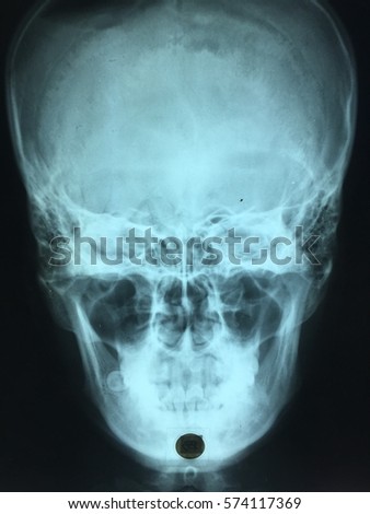 X ray skull picture