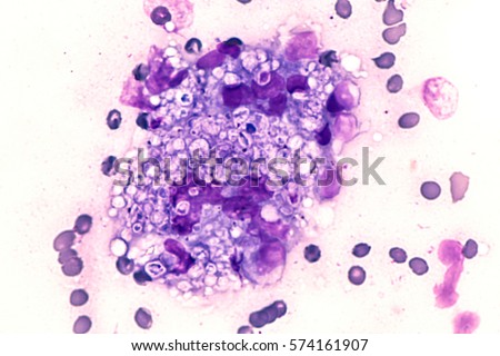 Fungal infection of lung, histoplasmosis: Fine needle aspirate (FNA)  of a pulmonary nodule showing  multinucleated  giant cells containing small bubble-like organisms of Histoplasma capsulatum.  Royalty-Free Stock Photo #574161907