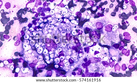 Fungal infection of lung, histoplasmosis: Fine needle aspirate (FNA)  of a pulmonary nodule showing  multinucleated  giant cells containing small bubble-like organisms of Histoplasma capsulatum.  Royalty-Free Stock Photo #574161916