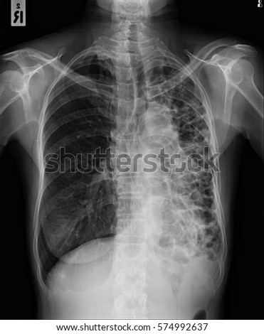 X-Ray Image a medical diagnosis : No change of multiple lucencies at the entire left lung with volume loss, could be due to cystic bronchiectasis