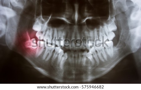 Panoramic x-ray image of teeth. Problem with wisdom tooth Royalty-Free Stock Photo #575946682