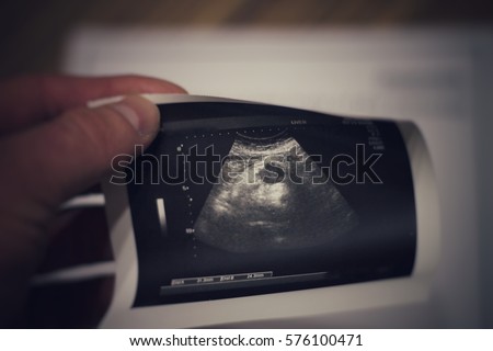 ultrasound photo. pancreatic cancer