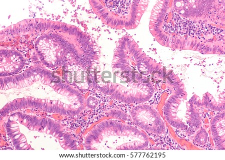 Microscopic image of a villous adenoma. Adenomas are premalignant (precancerous) polyps of the colon and rectum. Colonoscopy can prevent cancer by removing adenomas before they transform to cancer. Royalty-Free Stock Photo #577762195