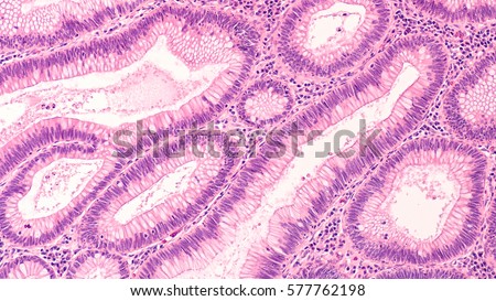 Microscopic (histology) of tubular adenoma. Adenomas are premalignant (precancerous) polyps of colon and rectum. Colonoscopy can prevent cancer by removing adenomas before they transform to cancer. Royalty-Free Stock Photo #577762198