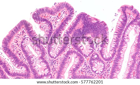 Microscopic image of a villous adenoma. Adenomas are premalignant (precancerous) polyps of the colon and rectum. Colonoscopy can prevent cancer by removing adenomas before they transform to cancer. Royalty-Free Stock Photo #577762201