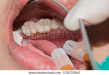 Close up of female patient mouth after teeth filling with beautiful white composite resin Royalty-Free Stock Photo #578733865
