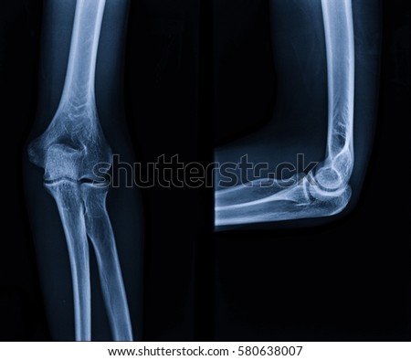 Film x-ray elbow : show normal human's elbow