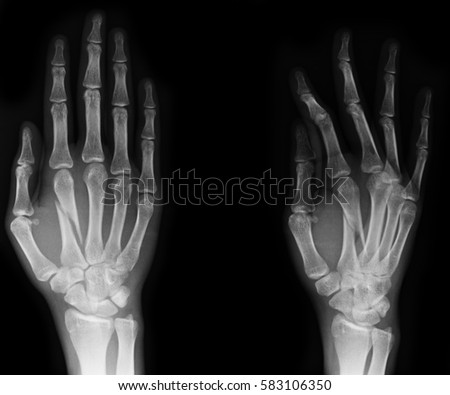 hand x-rays image show fracture bone