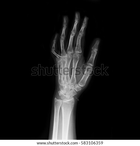 hand x-rays image show fracture bone