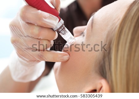 Needle mesotherapy, face lift. Microneedle mesotherapy, treatment woman at the beautician Royalty-Free Stock Photo #583305439