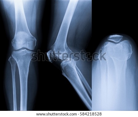 Film x-ray knee (AP,LAT,Skyline view) : show human's Knee