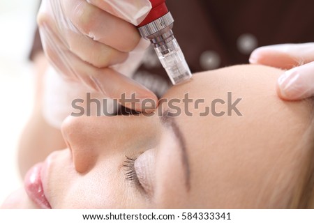 Needle mesotherapy,Microneedle mesotherapy, treatment woman at the beautician Royalty-Free Stock Photo #584333341