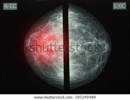 Mammography x-ray picture.