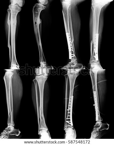 x-ray leg fracture and fixed in gray tone
