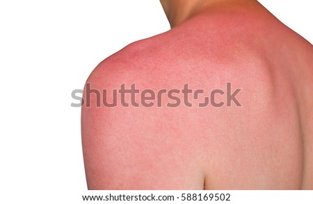 man with reddened, itchy skin after sunburn. Skin care and protection from the sun's ultraviolet rays.
