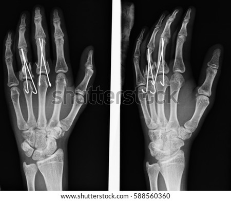 hand x-rays image with implant on x-ray film