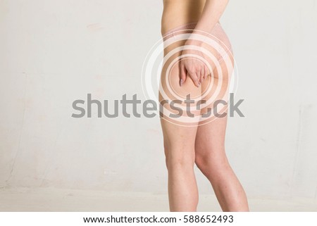 Cellulite is fat removal body. Woman pinches her thigh to control cellulite.