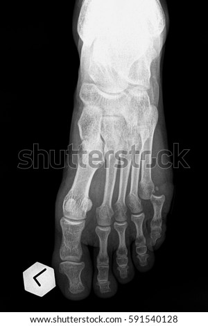 Fracture of the foot: the smallest finger Royalty-Free Stock Photo #591540128