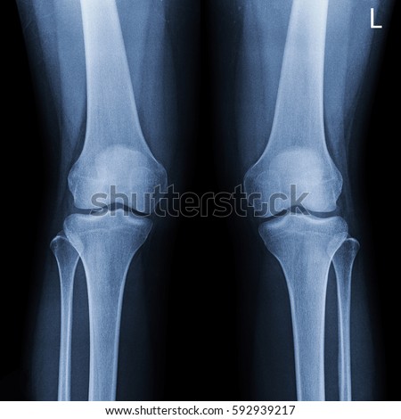 Film x-ray both knee joints (AP view)  : show normal human's both knee joints