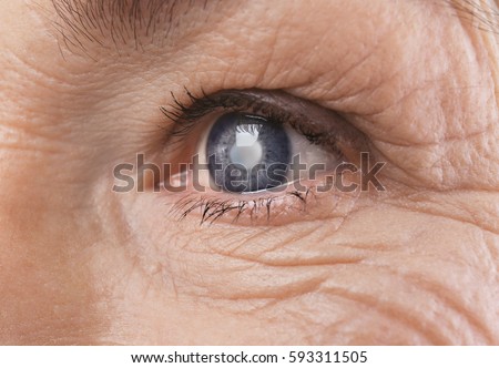 Cataract concept. Senior woman's eye, closeup Royalty-Free Stock Photo #593311505