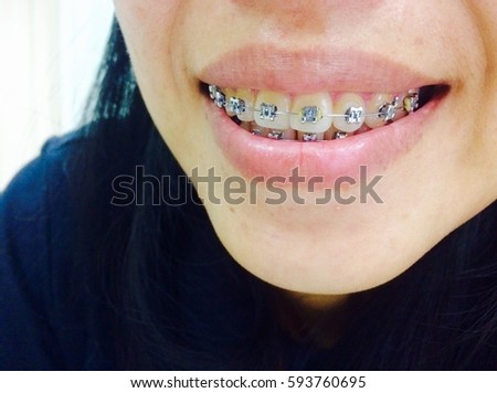 Dental Braces Damon. Close Up Female smile showing metal braces. Royalty-Free Stock Photo #593760695