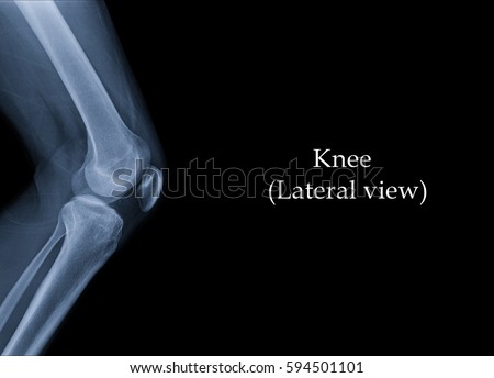 Film x-ray knee (Lateral view) : show human's Knee