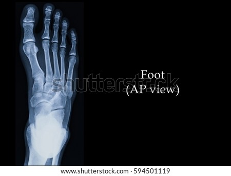 Film x-ray foot (AP view) : show normal human's foot.