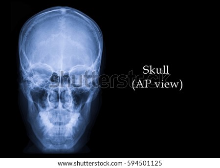 Film x-ray Skull anteroposterior (AP) view : show normal human's skull