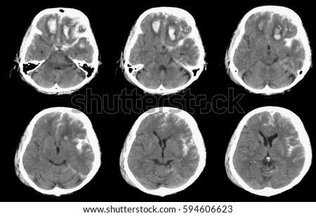 Computed tomography (CT) of brain : SDH at left frontotemporoparietal convexity and right frontotemporal convexity / SAH in cortical sulci of left frontoparietotemporal lobe Royalty-Free Stock Photo #594606623