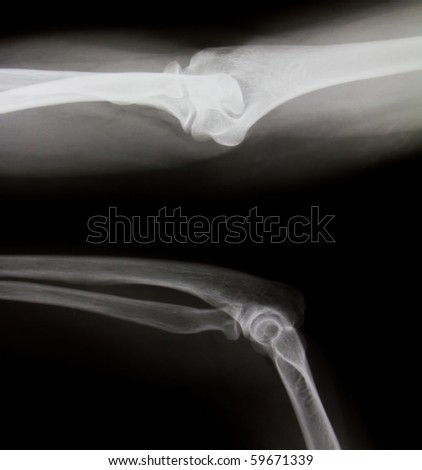 X-ray of both human legs (normal legs)