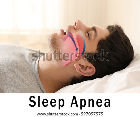 Snore problem concept. Illustration of obstructive sleep apnea Royalty-Free Stock Photo #597057575